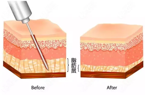 抽脂手術對身體有什么傷害？該不該禁止抽脂手術？